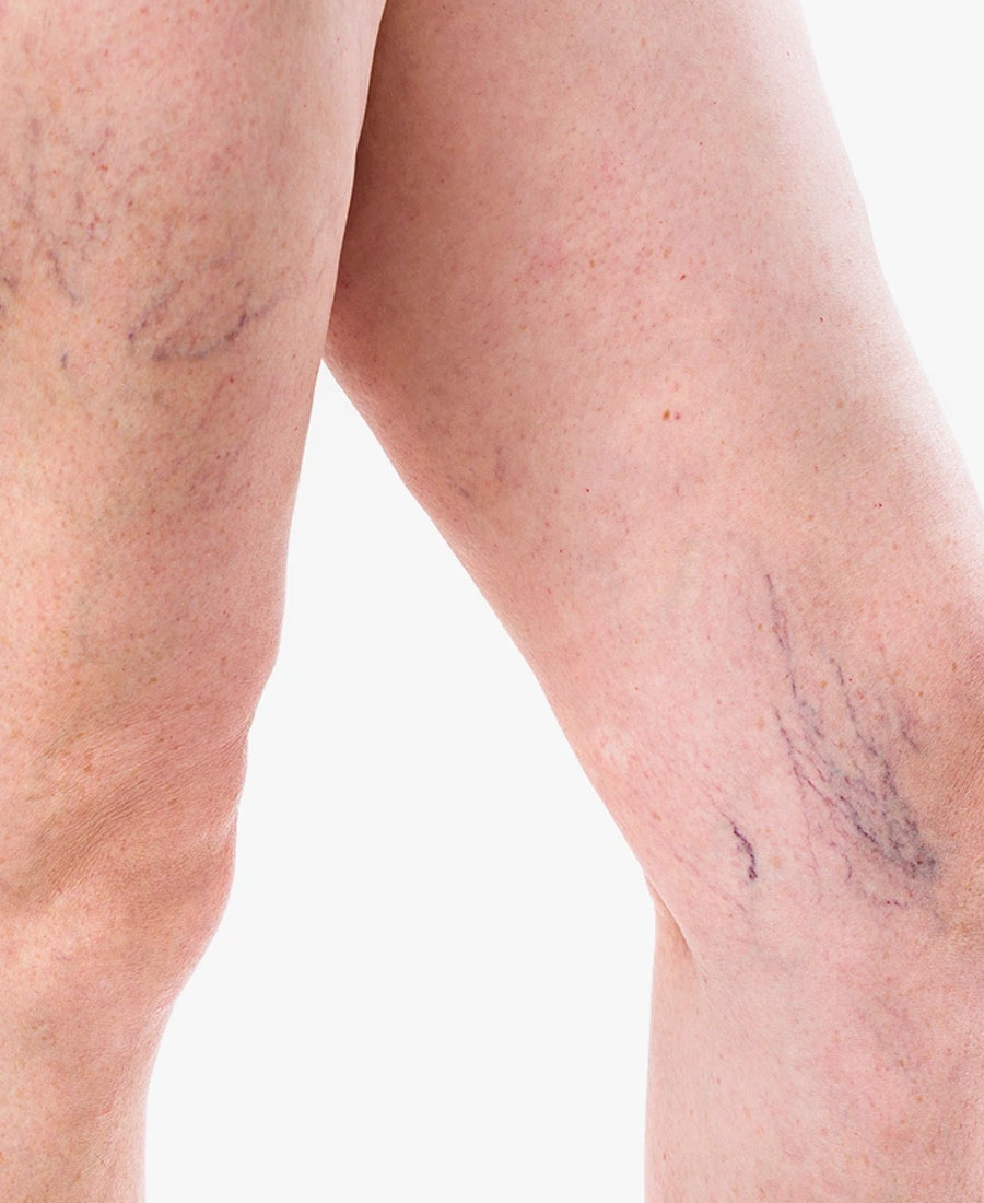Laser Vein Treatment Prep and Aftercare